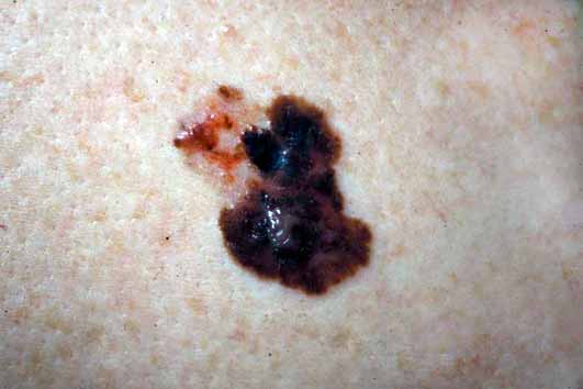 Image illustrating a mole with irregular coloring