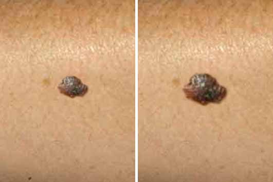 Image illustrating a mole with evolving coloration and size
